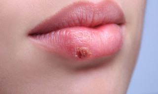 嘴唇干裂脱皮是什么原因 嘴唇干裂脱皮是什么原因怎么治疗