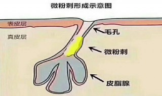 如何有效应对毛孔堵塞（如何有效应对毛孔堵塞的方法）