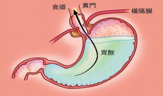 有点胃酸怎么办 有点胃酸怎么办缓解