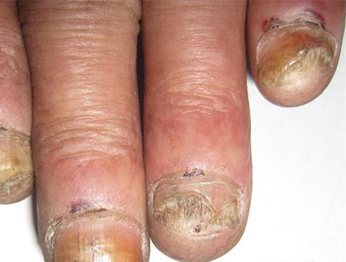灰指甲的初期症状（宝宝灰指甲的初期症状）