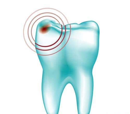 牙疼怎么办立刻止疼 止牙痛的最快速方法