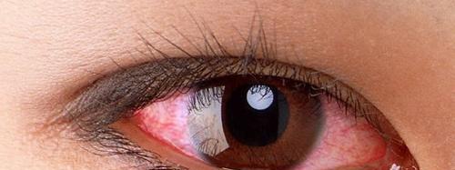 眼睛红血丝是怎么回事 长期看手机眼睛红血丝是怎么回事