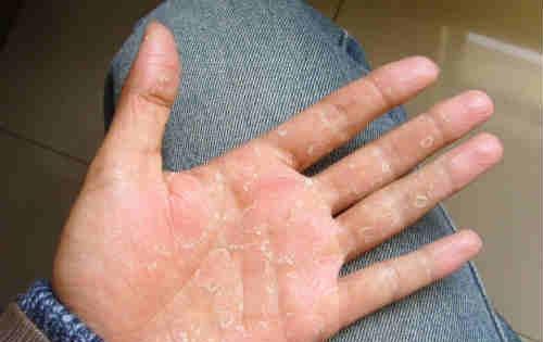 季节性手脱皮 季节性手脱皮是缺什么维生素