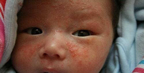 过敏性湿疹 过敏性湿疹是什么原因引起的