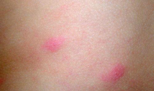 胆碱能性荨麻疹症状