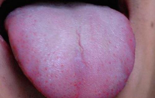 艾滋病初期舌头症状