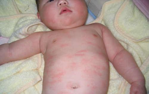 寒冷性荨麻疹的治疗方法
