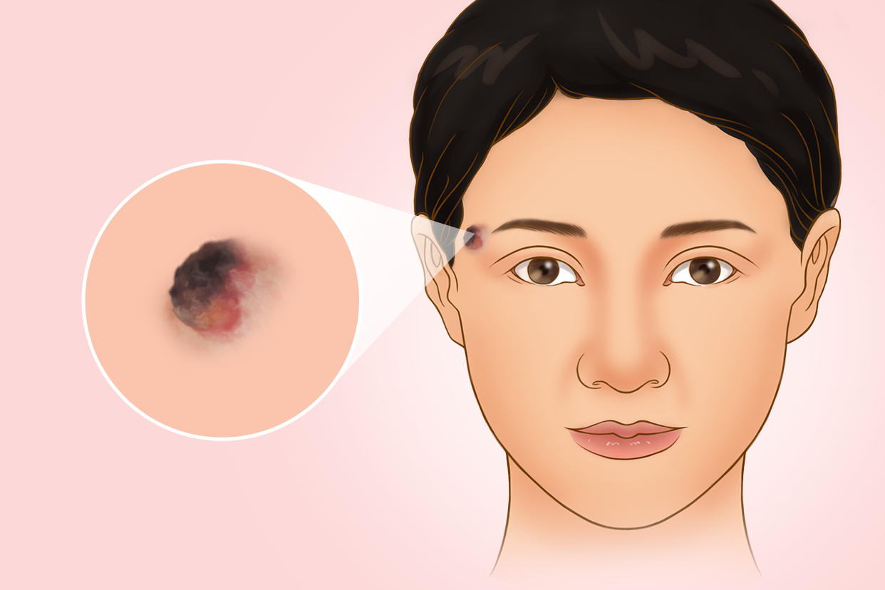 疣状丘疹图片和症状 什么是疣状丘疹