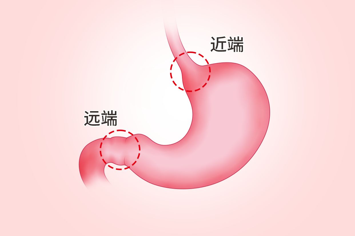 胃远端与近端的区别图 胃远端与近端的区别图解