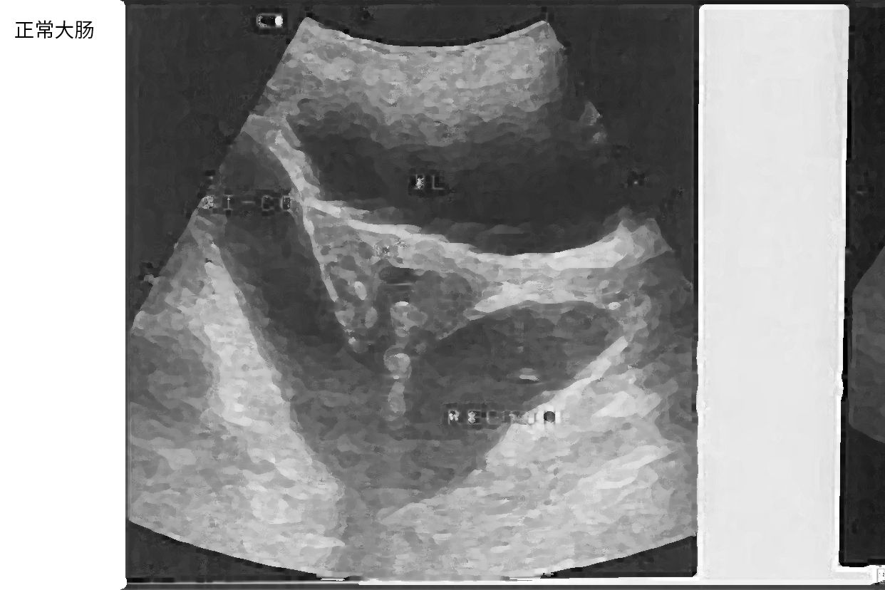 大肠和小肠的超声图像（大肠和小肠的超声图像解析）