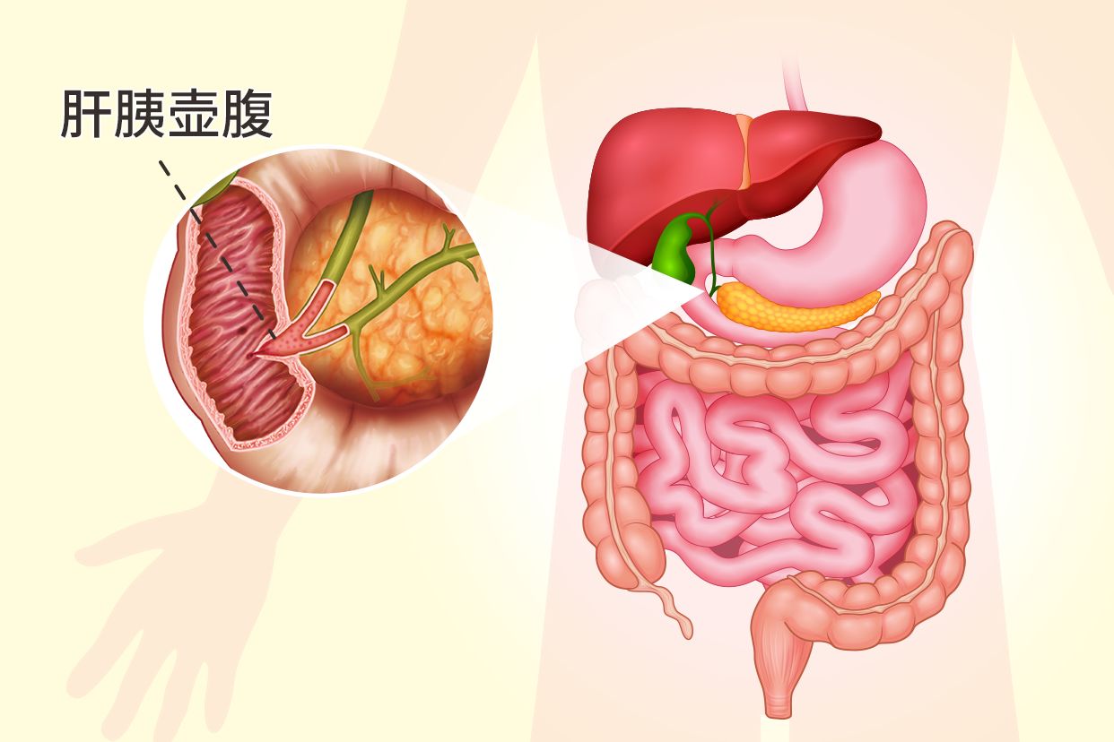 肝胰壶腹部在哪个位置图片 肝胰壶腹部开口于哪里