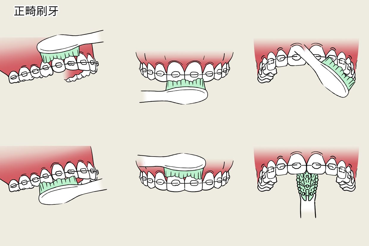 正畸刷牙步骤图片（正畸刷牙流程）