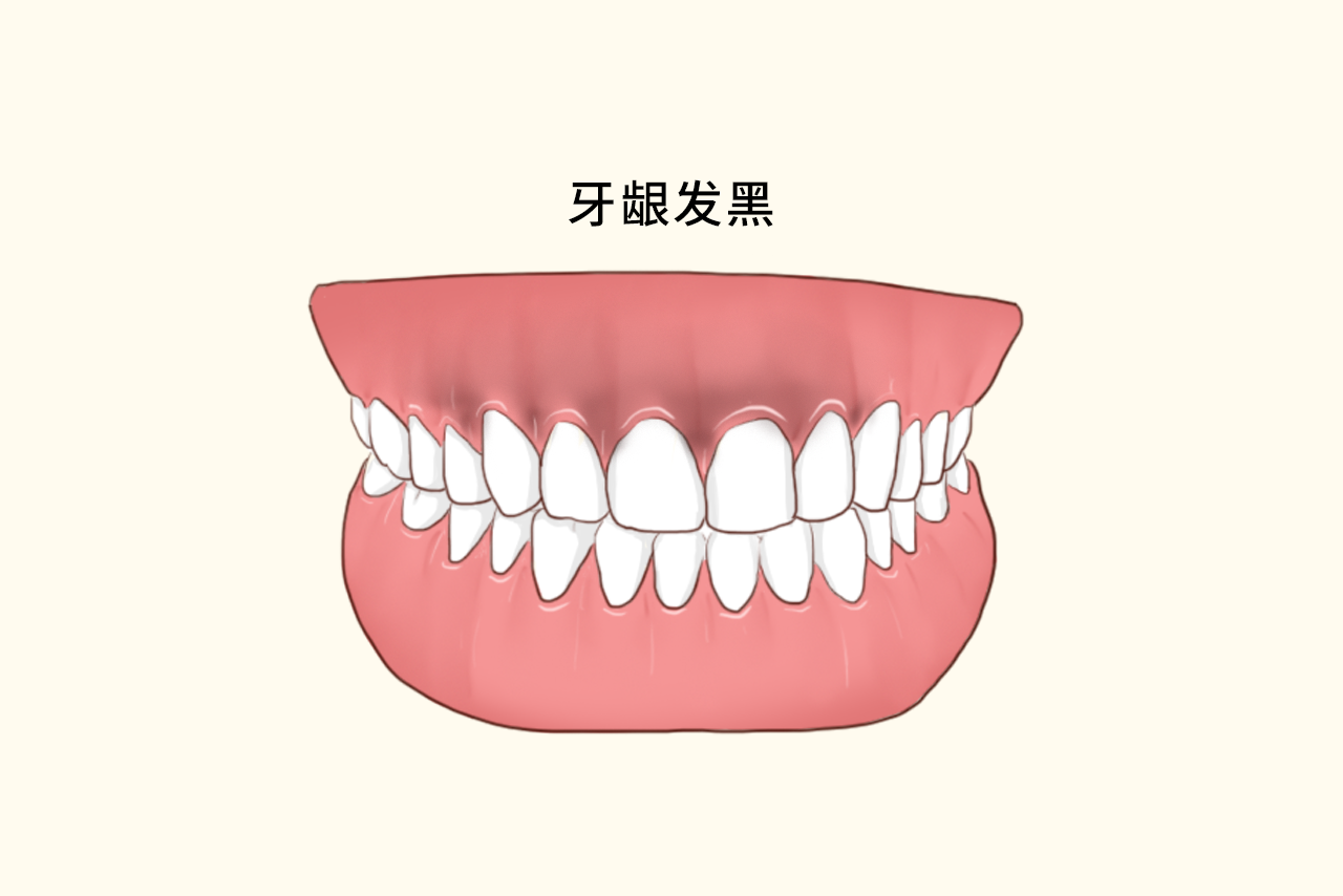 牙齿矫正后牙龈发黑的图片 牙齿矫正后牙龈发黑的图片