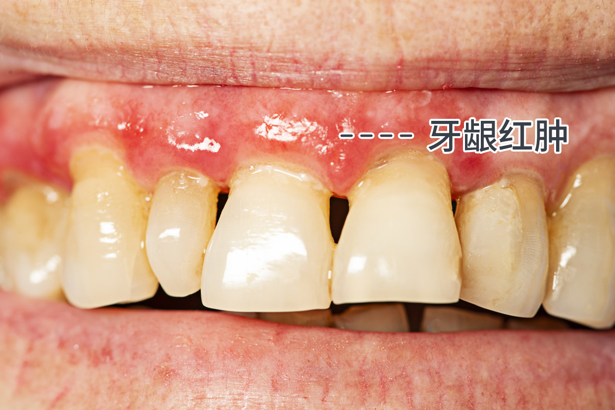 牙周炎牙龈红肿的图片 牙龈发炎红肿图片