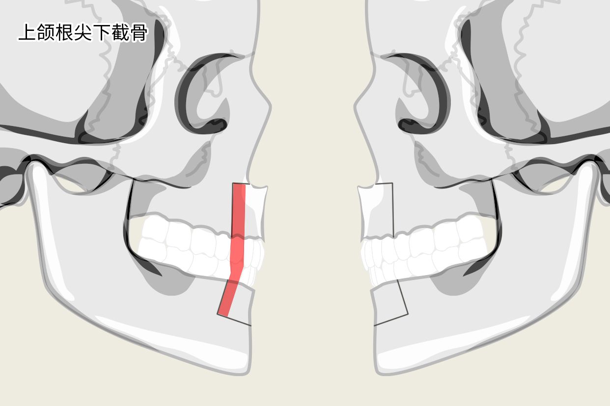 上颌根尖下截骨示意图 上颌前部截骨