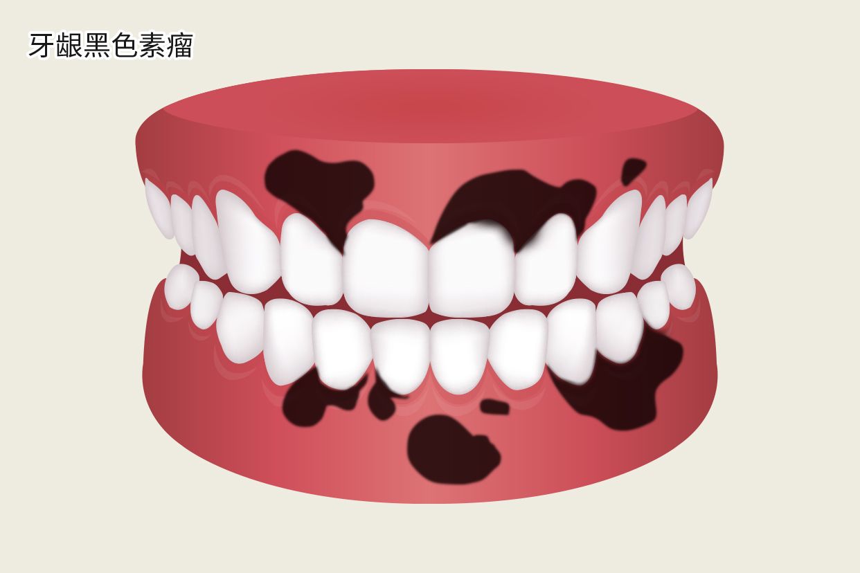牙龈黑色素瘤图片（牙龈黑色素瘤图片大全）