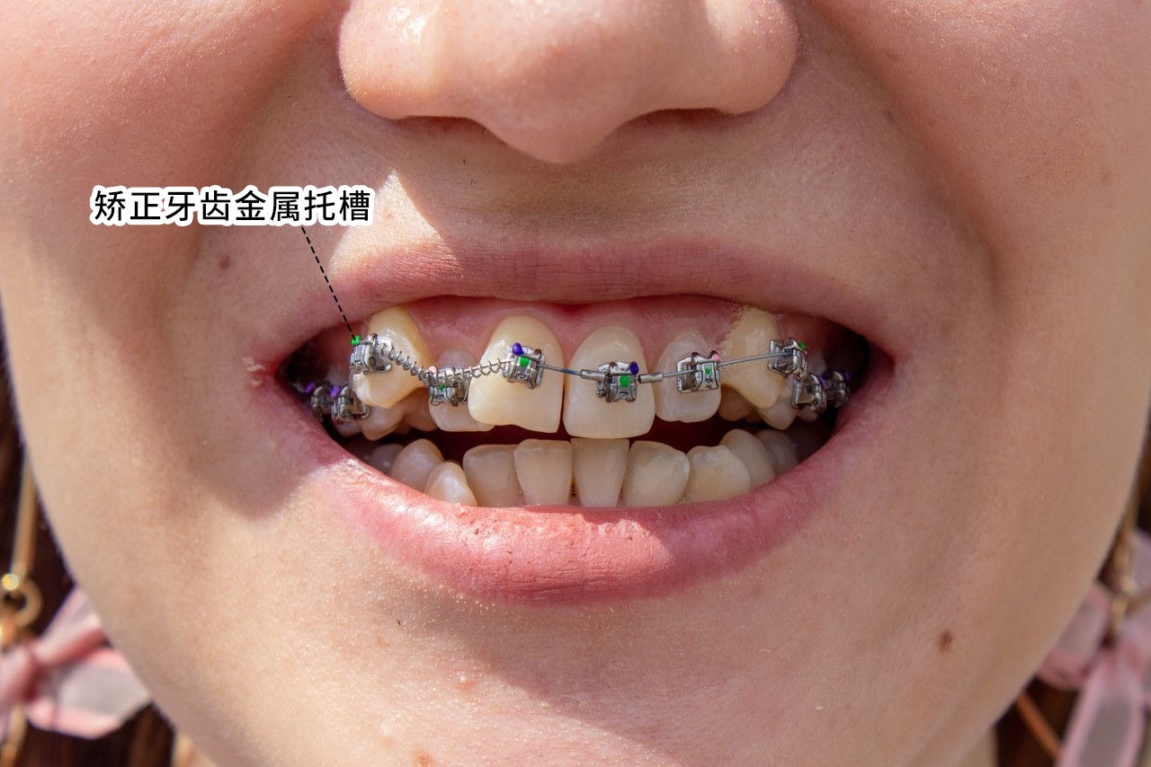 矫正牙齿金属托槽图片（牙齿矫正传统托槽图片）