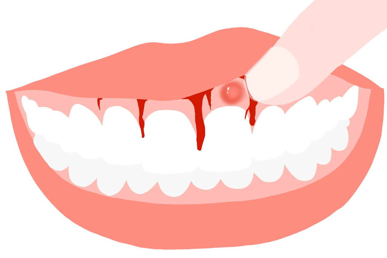 慢性重金属中毒牙龈图（牙齿重金属中毒的症状）