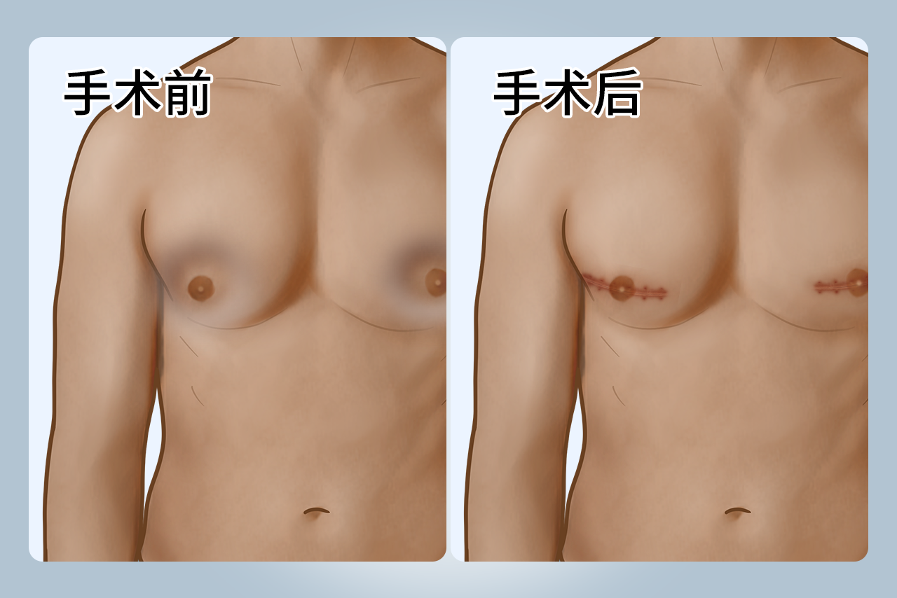 男性乳房手术后凹陷填充图片（男性乳房手术后凹陷填充图片大全）
