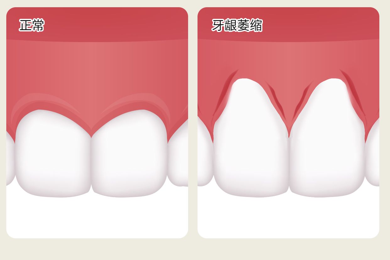 正常没萎缩的牙龈图片 正常没萎缩的牙龈图片真实