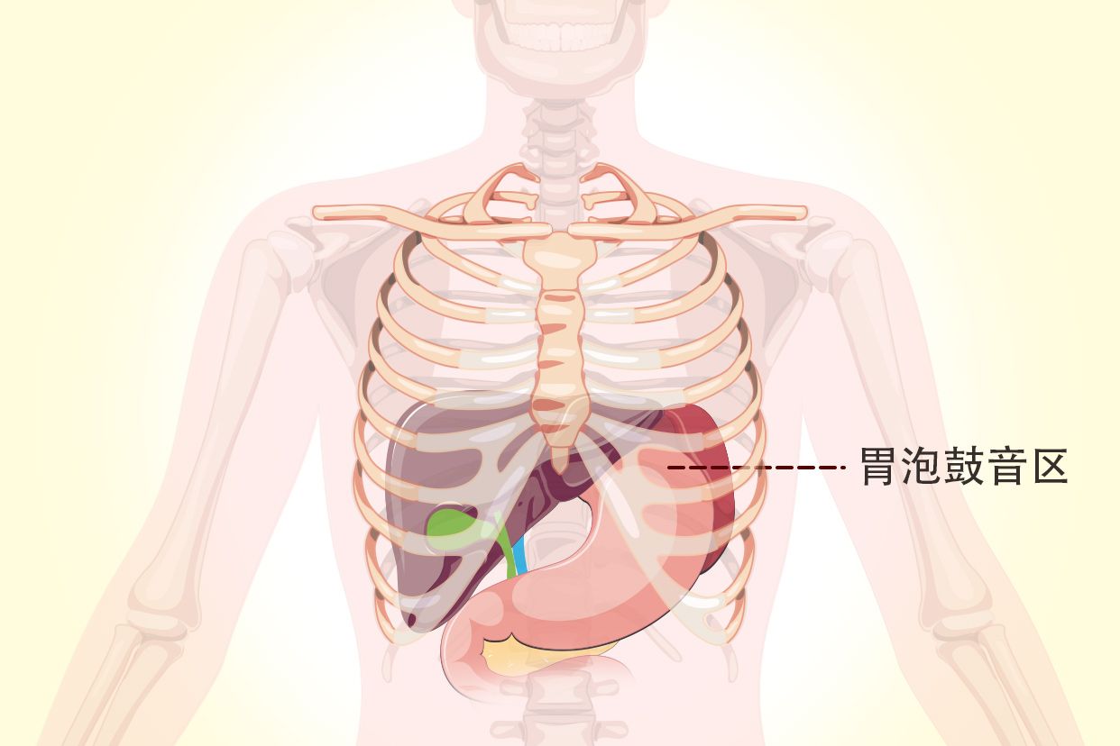 胃泡鼓音区示意图 急性胃扩张胃泡鼓音区
