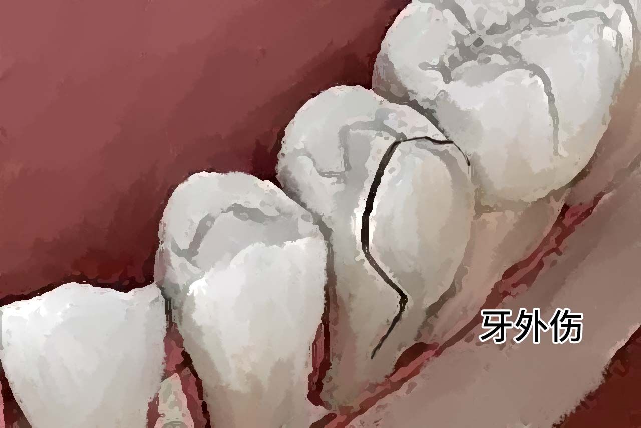 牙外伤图片（牙受伤的图片）