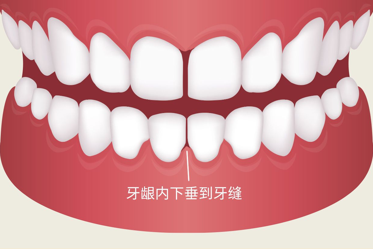 牙龈内下垂到牙缝是什么引起的图片（牙龈内下垂到牙缝是什么引起的图片和视频）