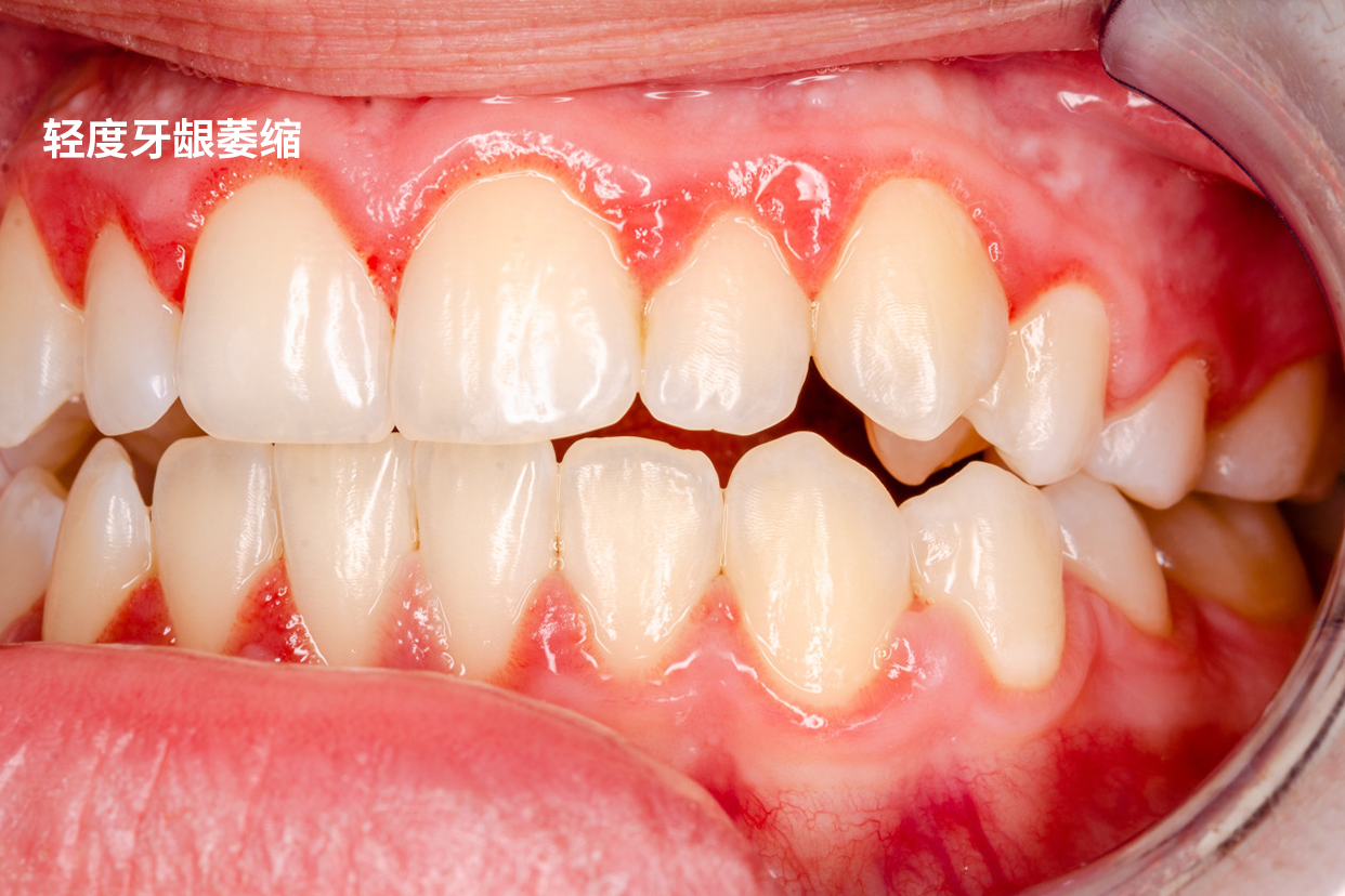 轻度牙龈萎缩图片初期 轻度牙龈萎缩图片牙龈图片