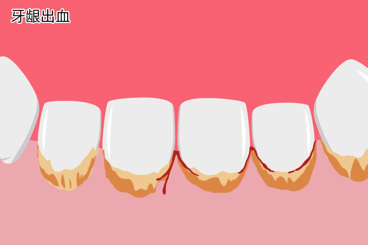 牙结石会导致牙龈出血吗图片 牙结石会导致牙龈出血吗图片
