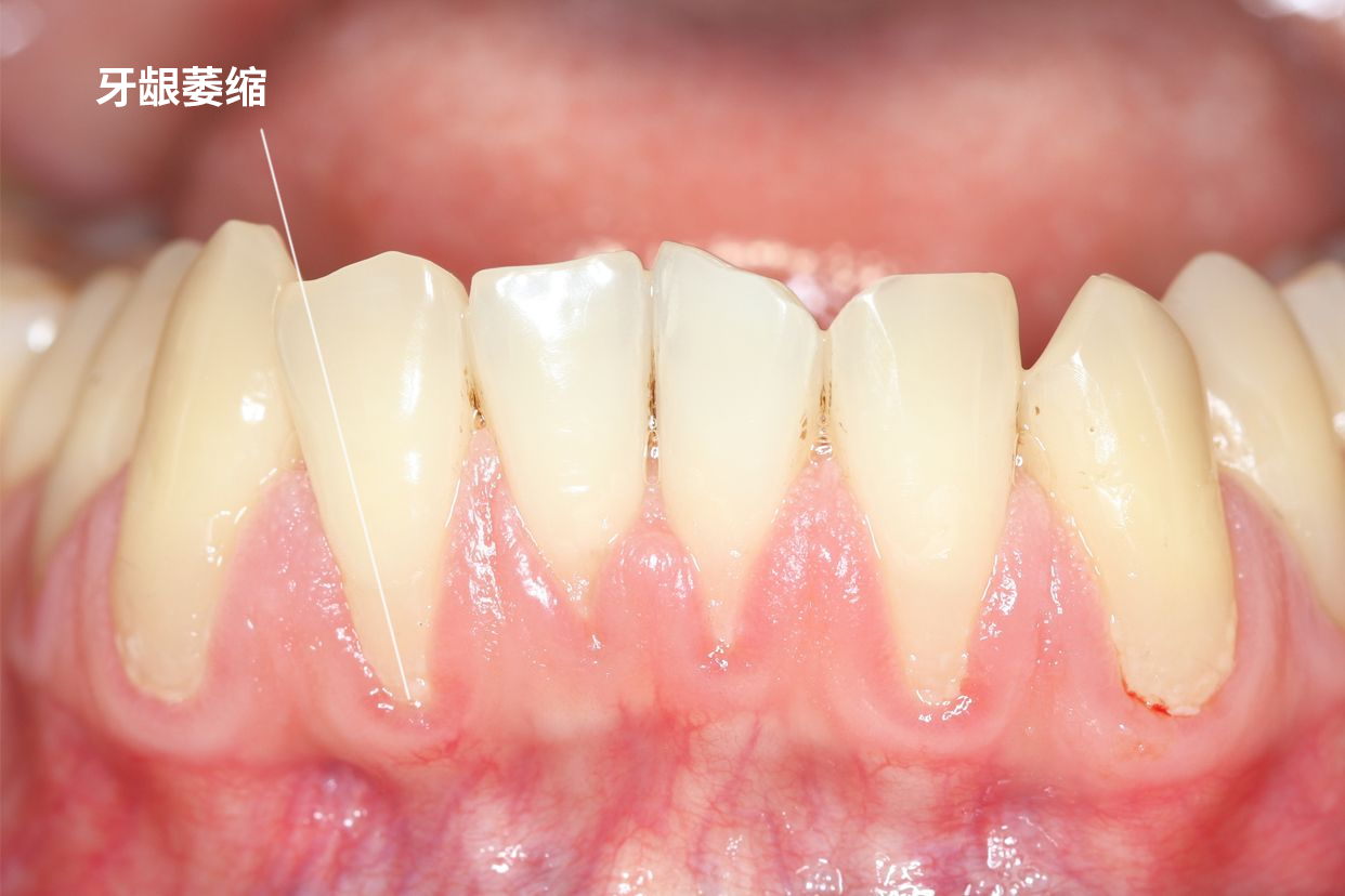 女人牙龈萎缩的图片 女人牙龈萎缩的原因