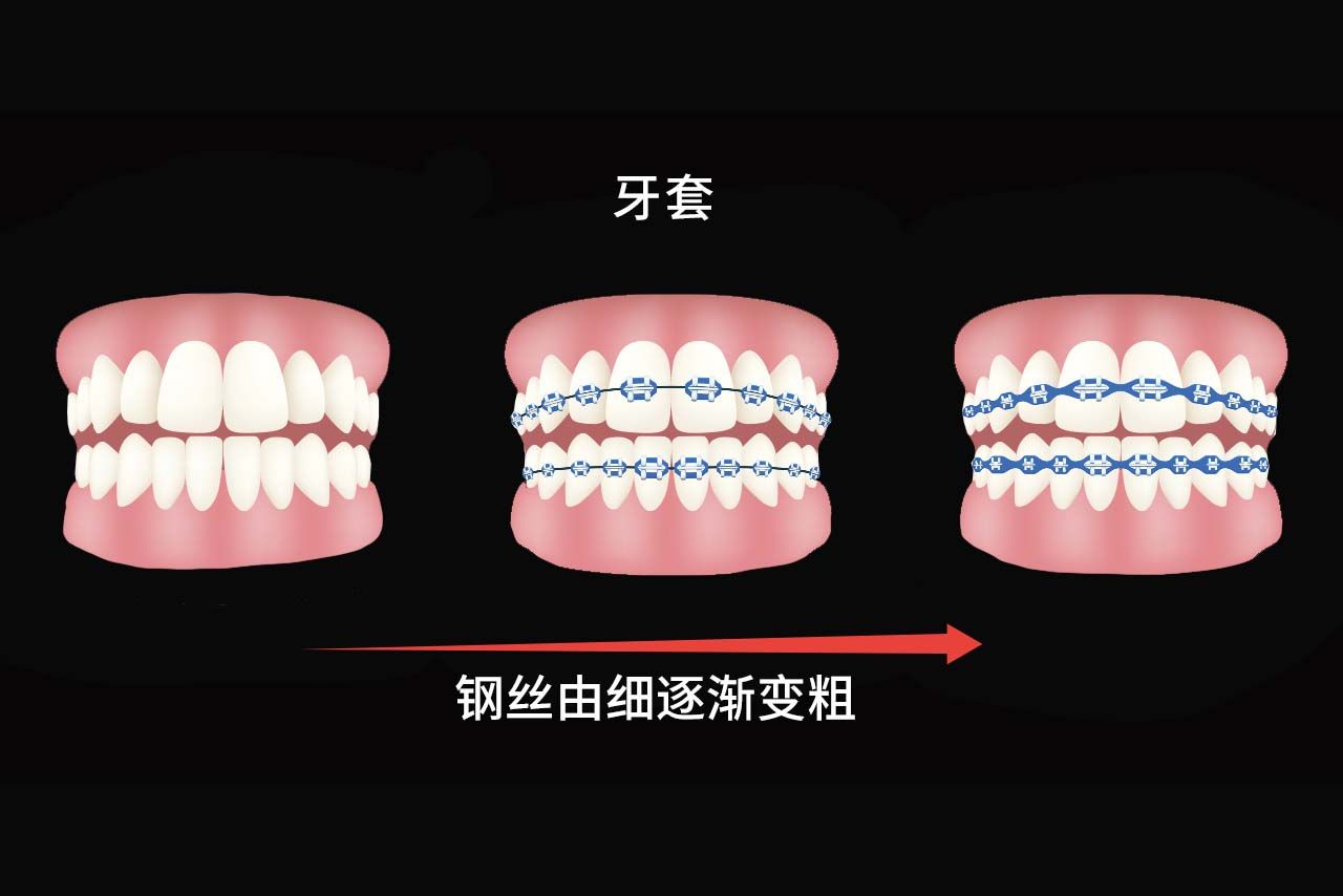 牙套换钢丝粗细顺序图片（戴牙套是每天都在移动吗）