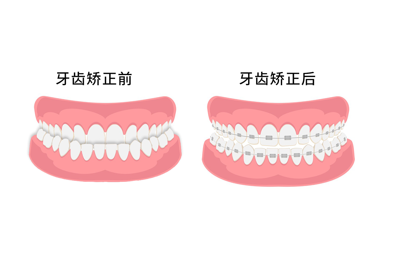 反颌牙齿矫正过程图片 反颌矫正的图片