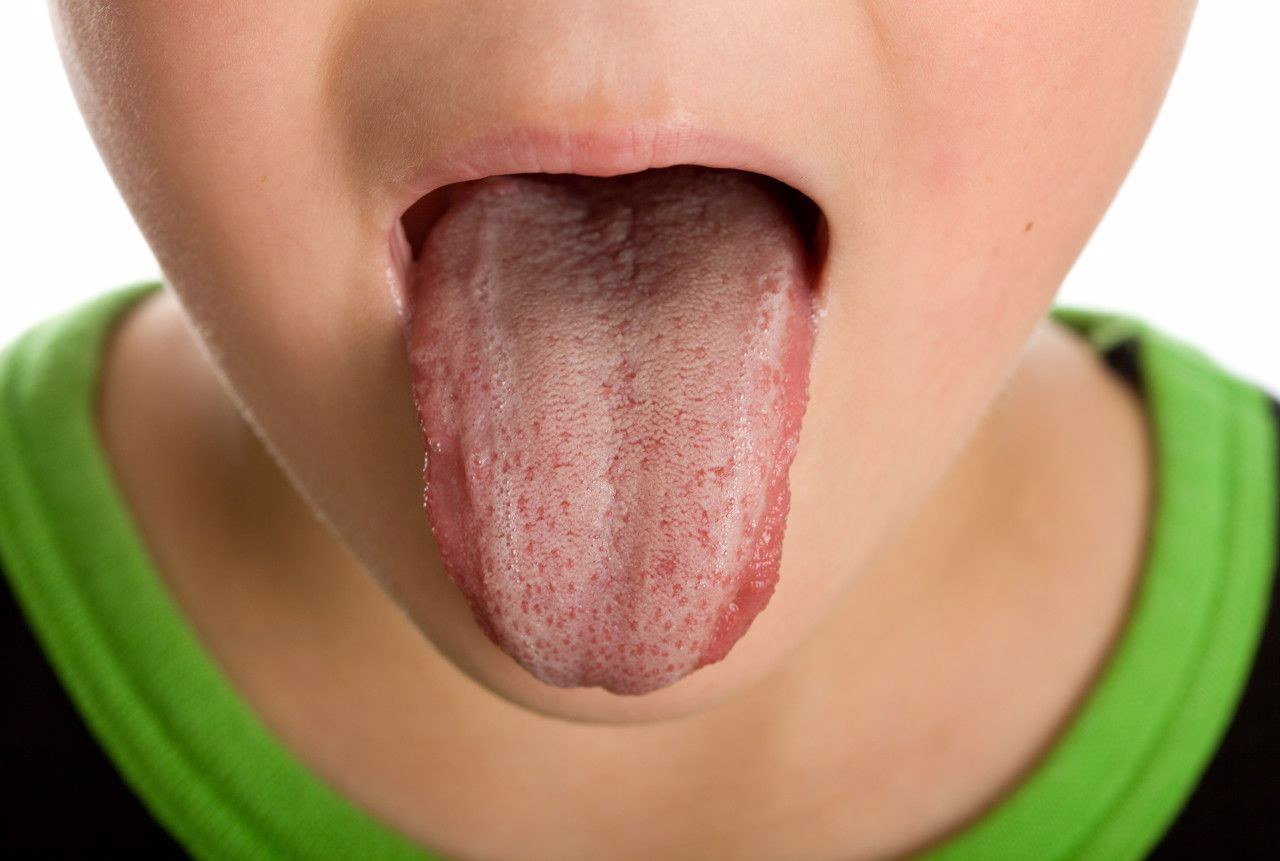 舌头上两边两条竖线图片（舌头上两边两条竖线代表什么）