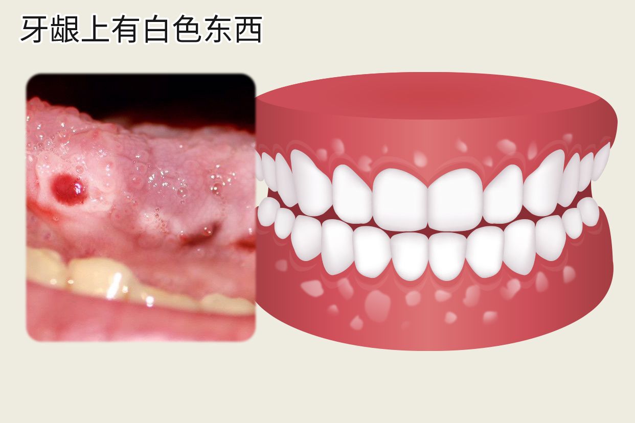 为什么牙龈上有白色东西图片 牙龈白斑初期症状图片