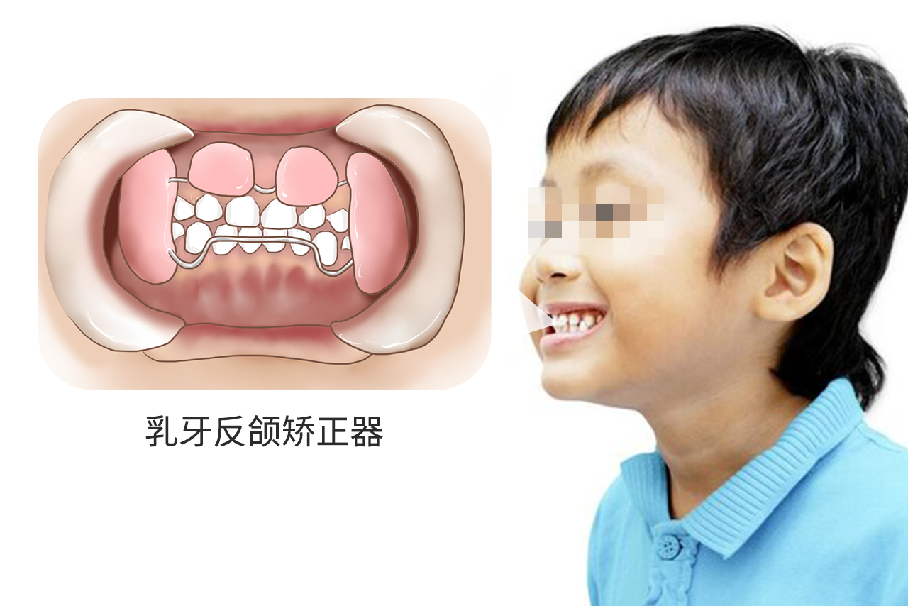 乳牙反颌矫正器图片（乳牙反颌矫正器图片）