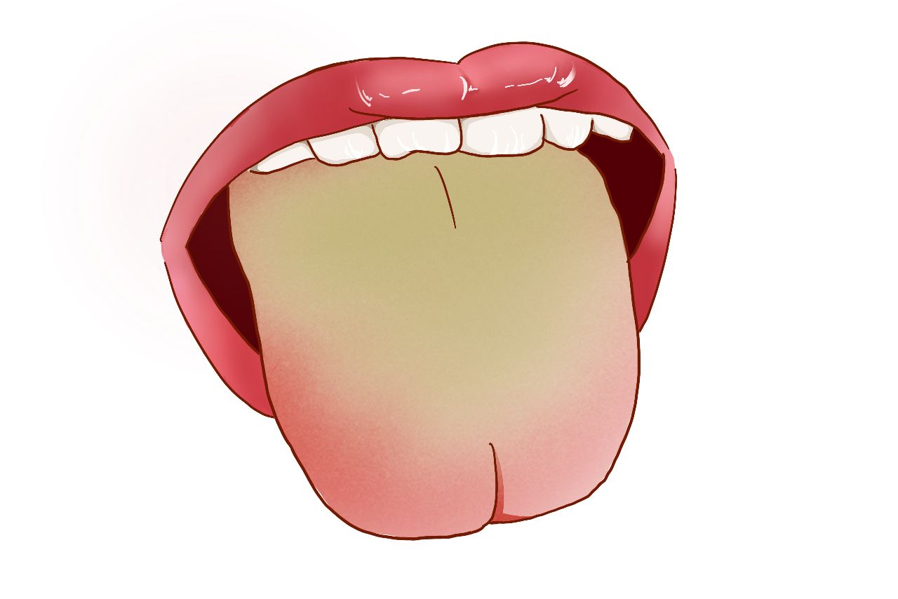 膀胱湿热舌苔图片（湿热的舌象图片）