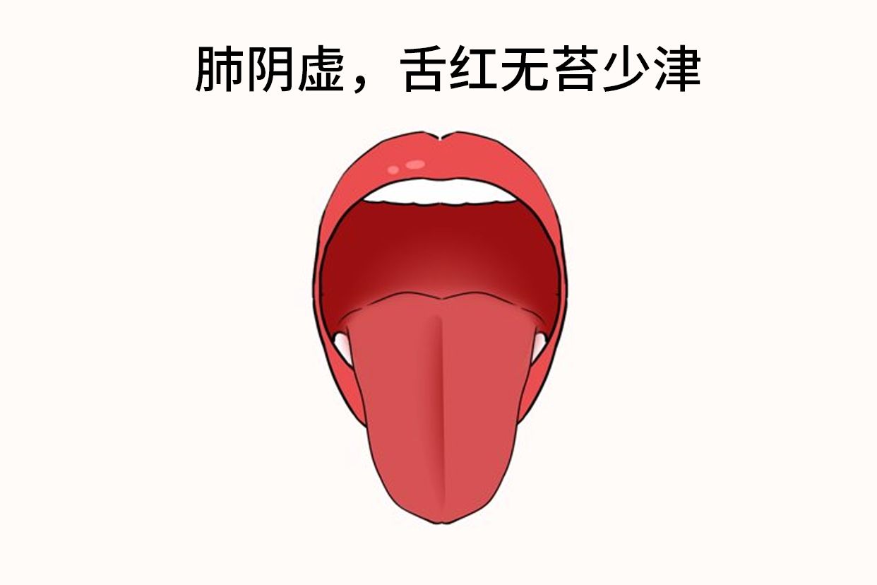 肺阴虚的舌头图片 肺阴虚舌苔怎么看