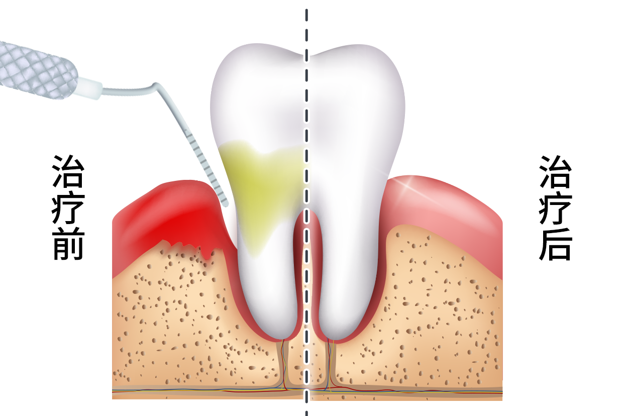 牙周炎牙缝修补效果图（补牙缝过程图解）