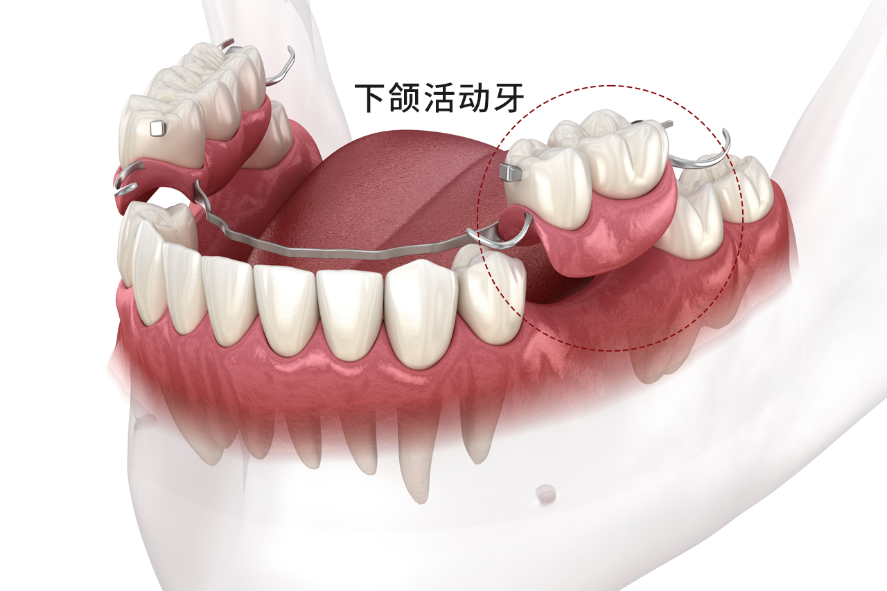 下颌活动牙图片（上颌活动牙图片）