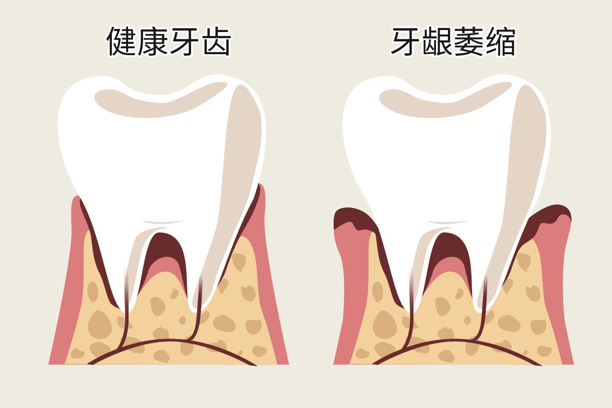 单个牙龈萎缩图片（单个牙龈萎缩图片大全）