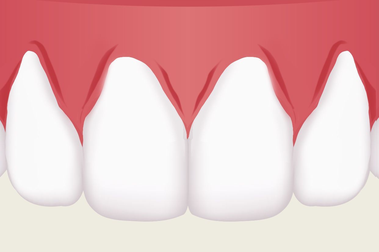 做一个牙龈修复效果图 牙龈修复图片
