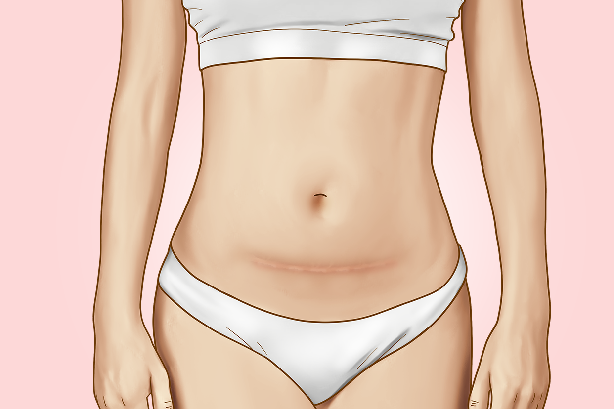 女生肚子上有刀疤是怎么回事图片 女人肚上有刀疤是什么情况