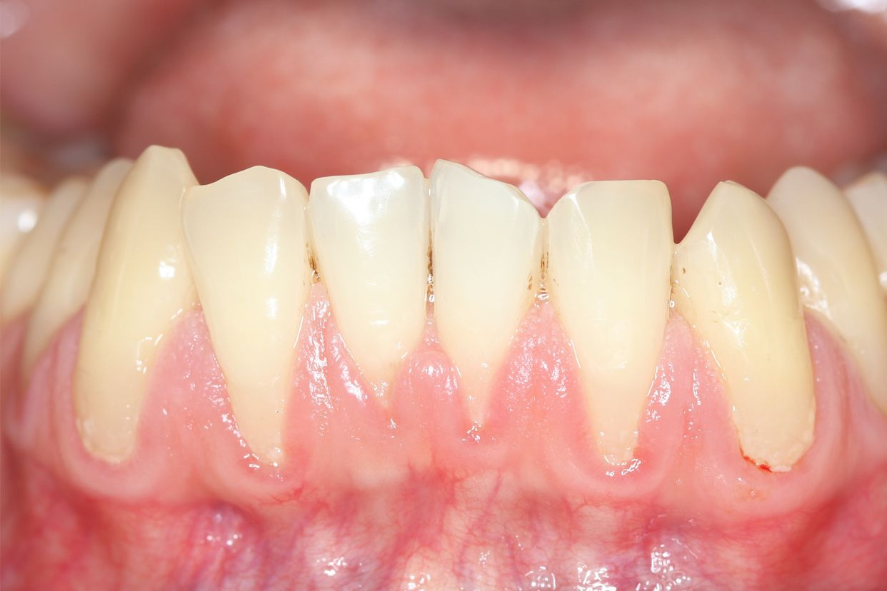 35岁牙龈萎缩图片（35岁牙龈萎缩图片及原因）