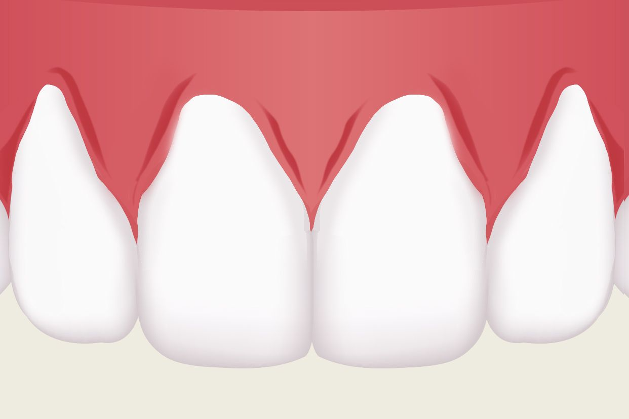 上排侧面牙牙龈萎缩图 下前牙牙龈萎缩图片