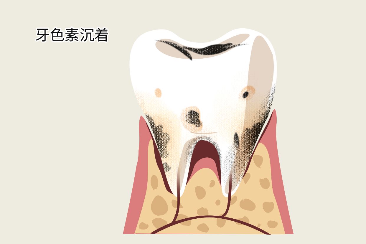 牙色素沉着和龋齿区别有图吗 牙体色素沉着和浅龋的区别