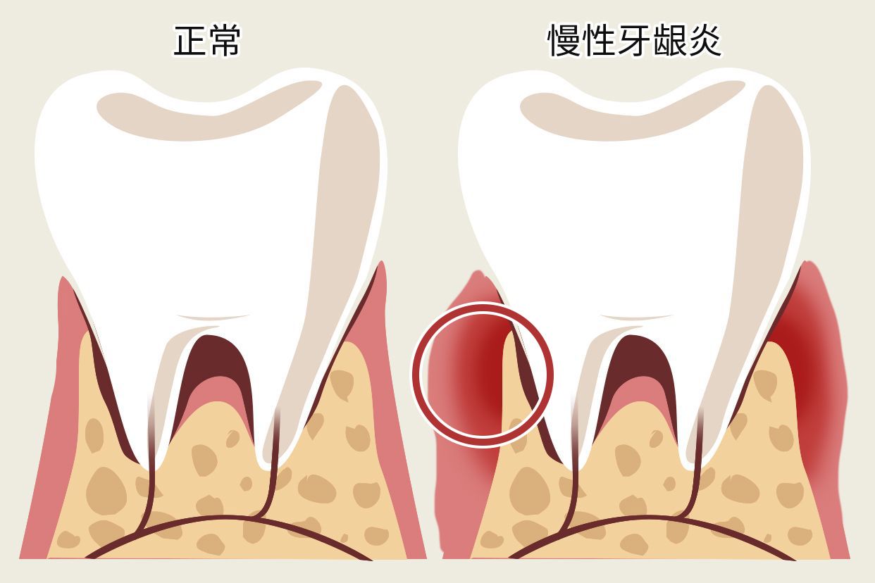 慢性牙龈炎图片 慢性牙龈炎的图片