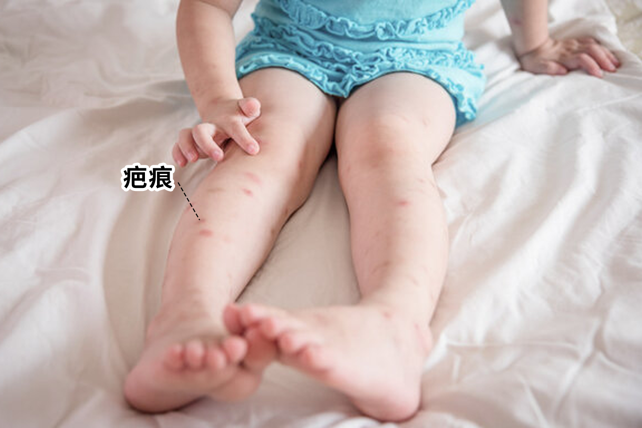小孩疤痕图片 小宝宝有疤的图片