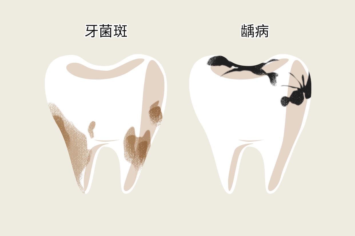 牙垢和蛀牙的区别图片 牙垢和蛀牙的区别图片大全