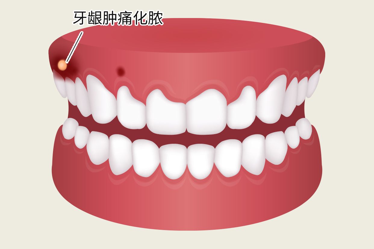 冠周炎牙龈肿痛化脓图片