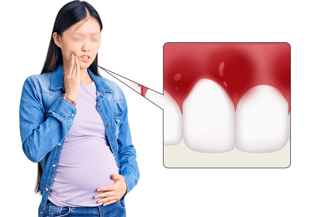 妊娠期牙龈炎图片